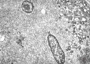 F,25y. | myopathy - atrophic and regenerating muscle cells